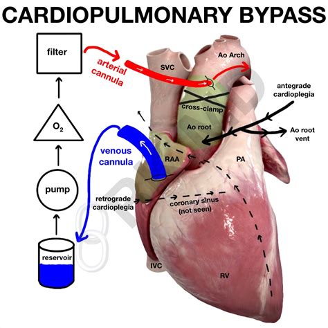 centrifugal pump system cardiopulmonary bypass|cardiopulmonary bypass explained.